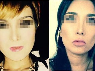 Antes y después de Bichectomía con aplicación de fillers para contorno de labios