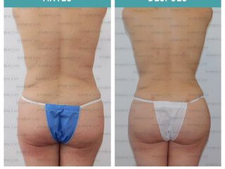 Antes y después de Lipoescultura con contorno en glúteos