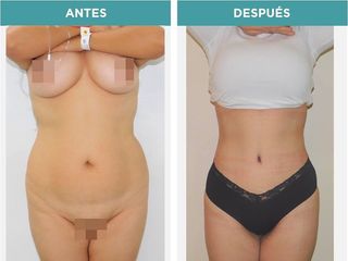 Antes y después de Abdominoplastia