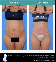 Antes y después de Abdominoplastia con lipoescultura