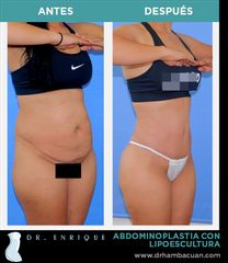 Antes y después de Abdominoplastia con lipoescultura