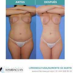 Antes y después de Lipoescultura con aumento de busto