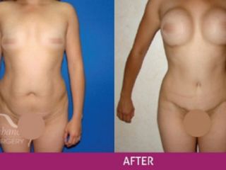 Antes y después de abdominoplastia