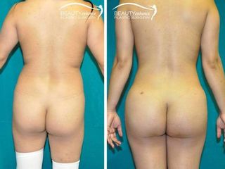 Antes y después de liposucción