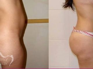 Antes y después de lipoescultura