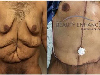 Antes y despues de tummy tuck