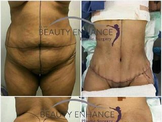 Antes y despues de tummy tuck