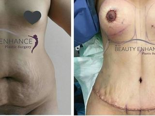Antes y después de tummy tuck