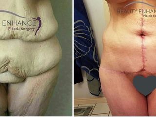 Antes y después de tummy tuck