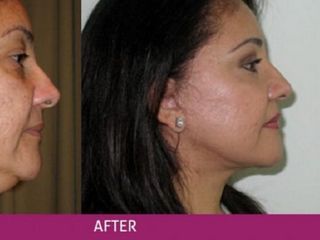 Antes y despues de rejuvenecimiento facial