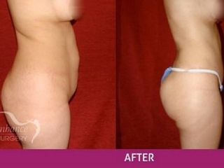 Antes y después de liposucción