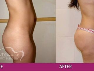 Antes y después de abdominoplastia