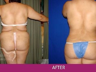 Antes y después liposucción