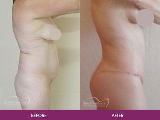 Antes y después de abdominoplastia