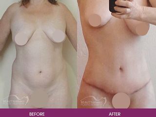 Antes y después de abdominoplastia