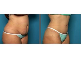 Antes y después de abdominoplastia