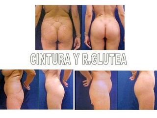 Antes y después de Lipoescultura