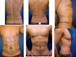 Antes y después de Marcación abdominal