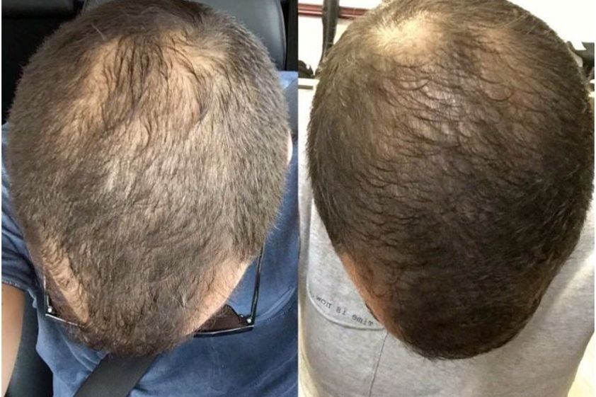 Alopecia antes y después - 643425
