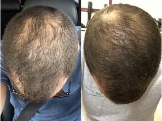 Antes y después de Regeneración de cabello con células madre