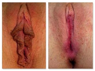 Rejuvenecimiento Vaginal antes y después - 643426