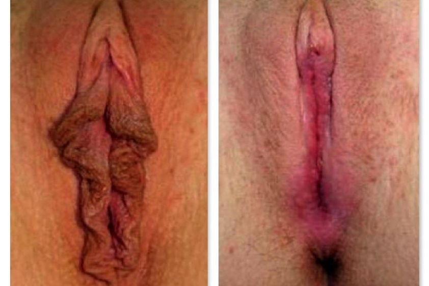 Rejuvenecimiento Vaginal antes y después - 643426