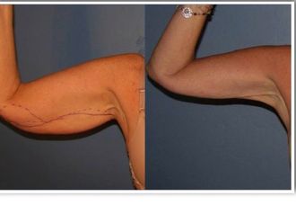 Braquioplastia - 643427