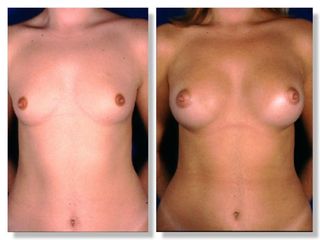 Antes y después de Mamoplastia