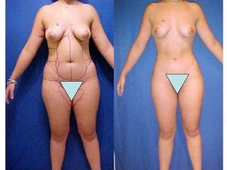 Antes y después de Lipoescultura