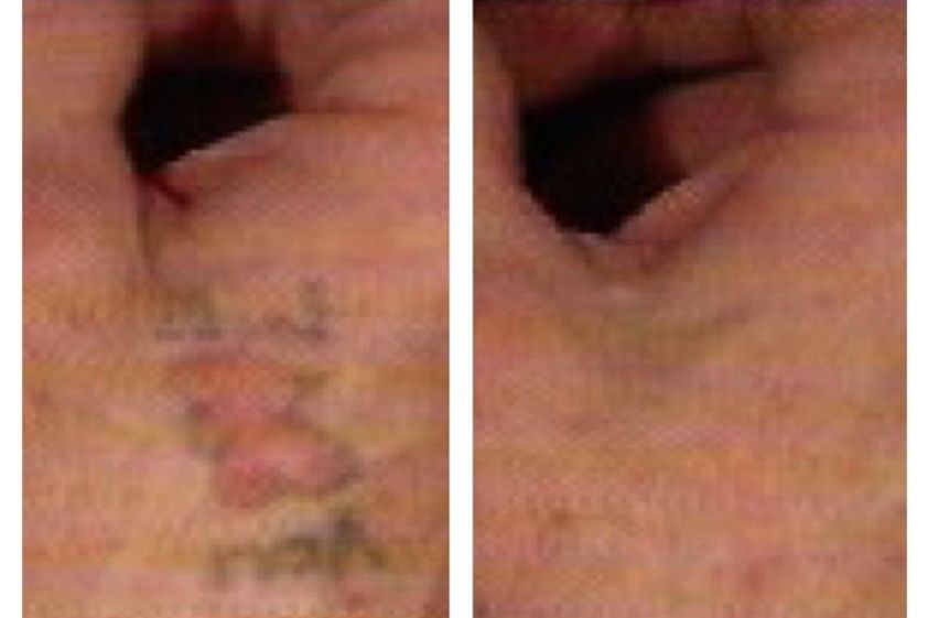 Eliminación de tatuajes antes y después - 643431