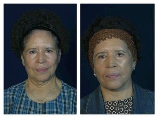 Antes y después de Lifting facial