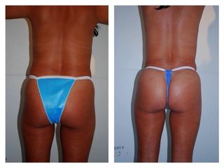 Antes y después de Abdominoplastia, liposucción y mamas de aumento.