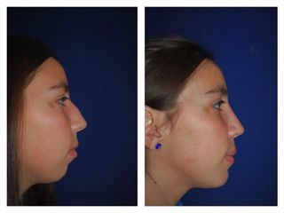 Antes y después de Rinoplastia y mentoplastia