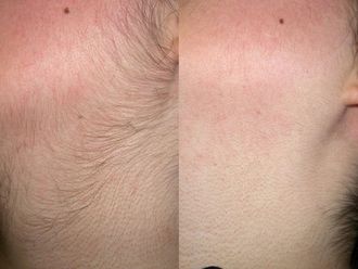 Depilación láser antes y después - 643442