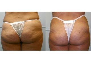 Antes y después de Radiofrecuencia