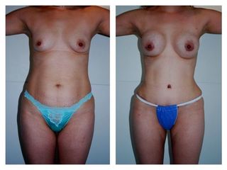 Antes y después de Aumento mamario y abdominoplastia
