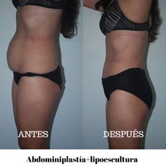 Antes y después de Abdominiplastía+lipoescultura