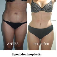 Antes y después de Abdominoplastia