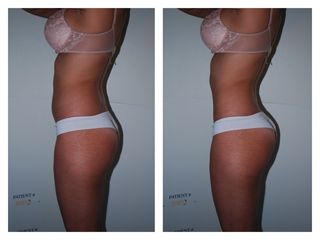 Abdominoplastia - Dr. Luis Francisco García Fabián