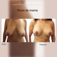 Mastopexia - Dra. María Del Carmen Damian Tovar