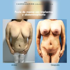 Mastopexia + Abdominoplastia - Dra. María Del Carmen Damian Tovar