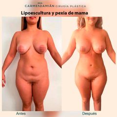 Lipoescultura - Dra. María Del Carmen Damian Tovar