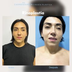 Rinoplastia - Dra. María Del Carmen Damian Tovar