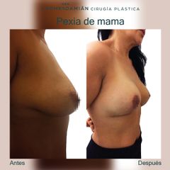 Mastopexia - Dra. María Del Carmen Damian Tovar