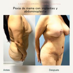 Aumento de busto - Dra. María Del Carmen Damian Tovar