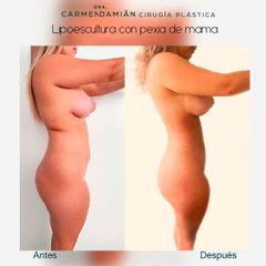 Liposucción - Dra. María Del Carmen Damian Tovar