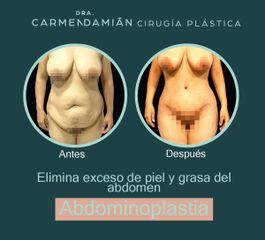 Abdominoplastia - Dra. María Del Carmen Damian Tovar