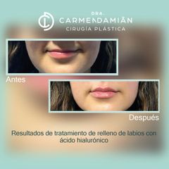 Aumento de labios - Dra. Carmen Damián