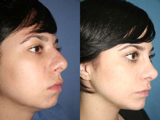 Antes y después de Cirugía combinada - Rinoplastia y bolsas de bichat