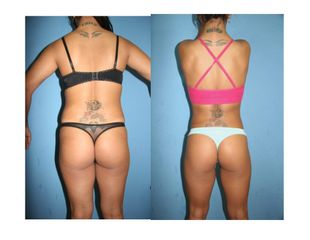 Antes y después de Lipoescultura